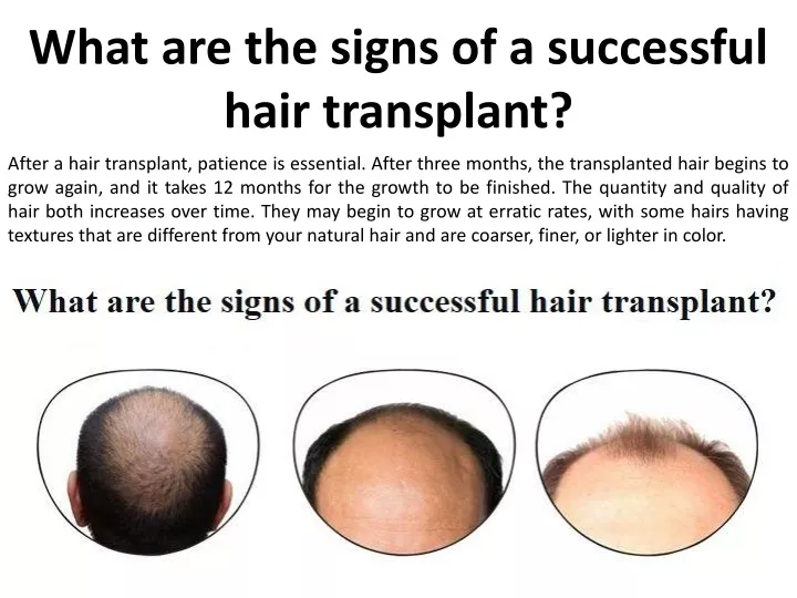 what are the signs of a successful hair transplant