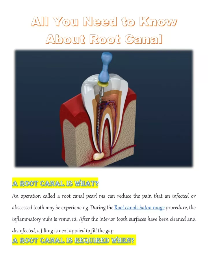 an operation called a root canal pearl