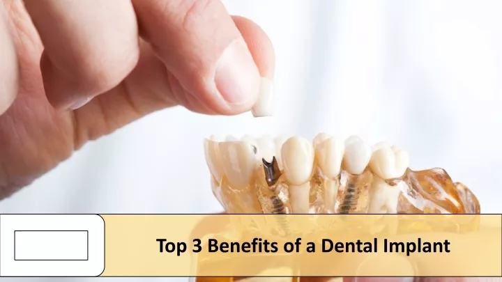 top 3 benefits of a dental implant