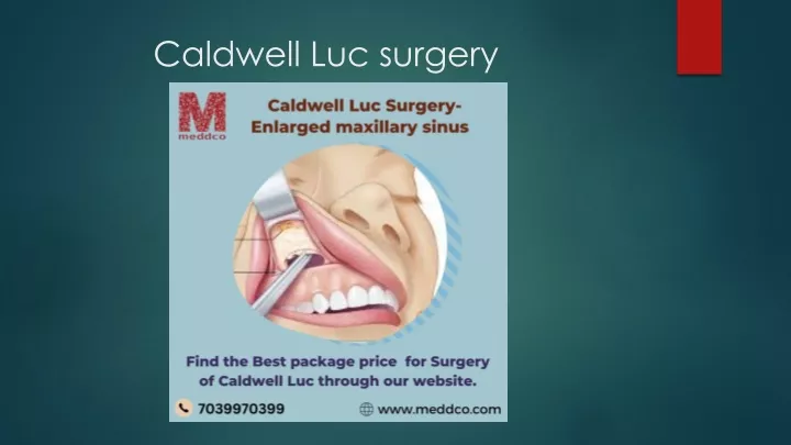 caldwell luc surgery