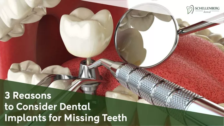 3 reasons to consider dental implants for missing