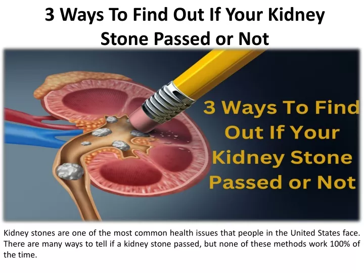 3 ways to find out if your kidney stone passed