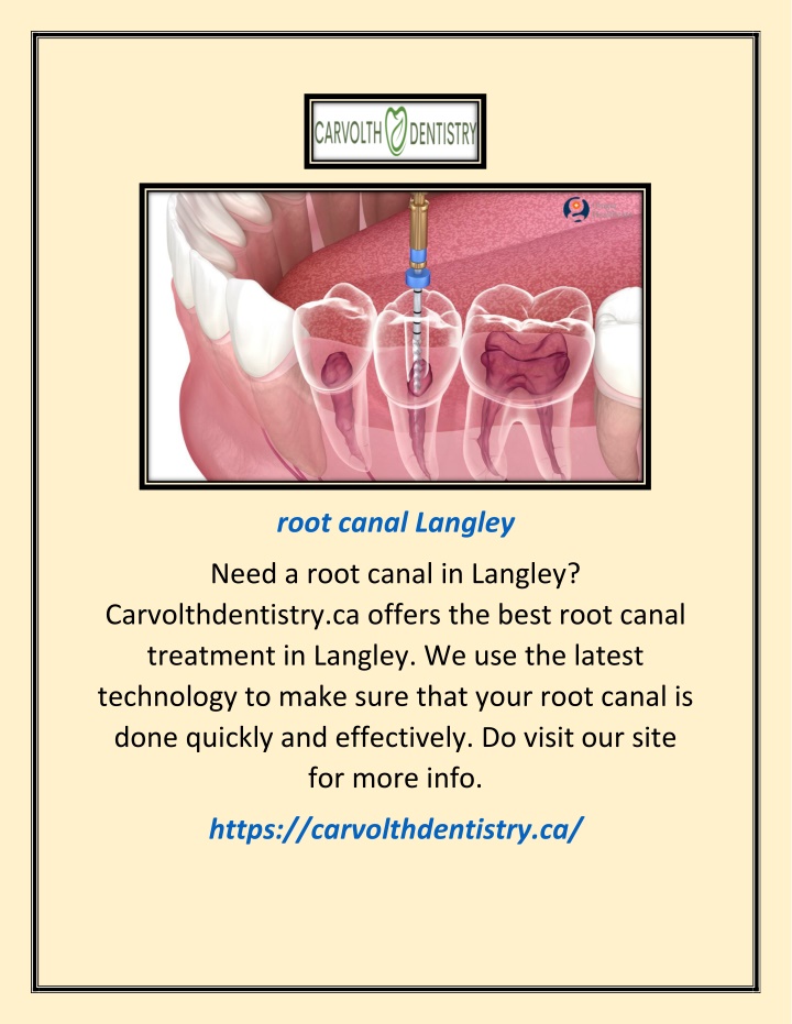 root canal langley