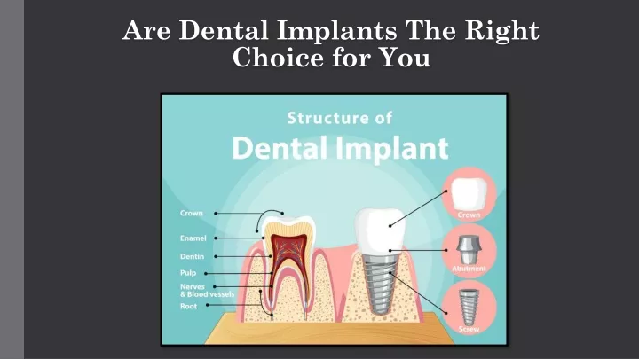 are dental implants the right choice for you