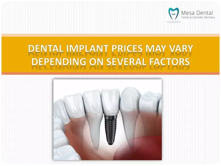 dental implant prices may vary depending on several factors