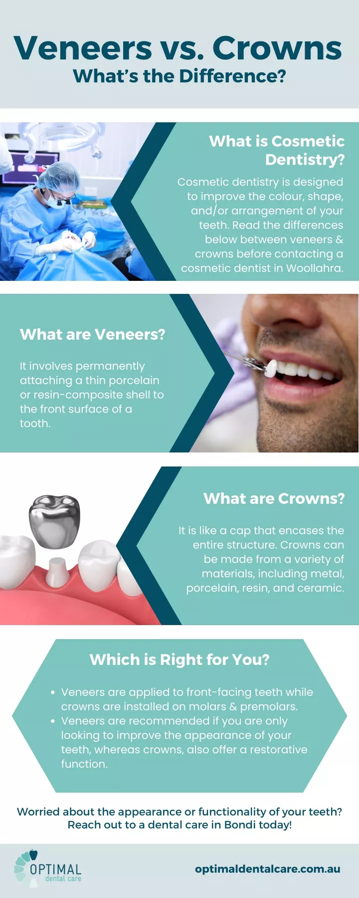 veneers vs crowns what s the difference