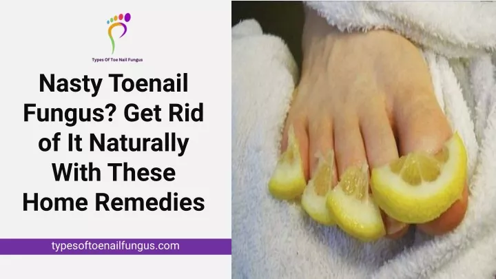 nasty toenail fungus get rid of it naturally with