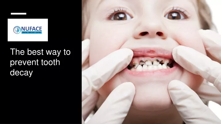 the best way to prevent tooth decay