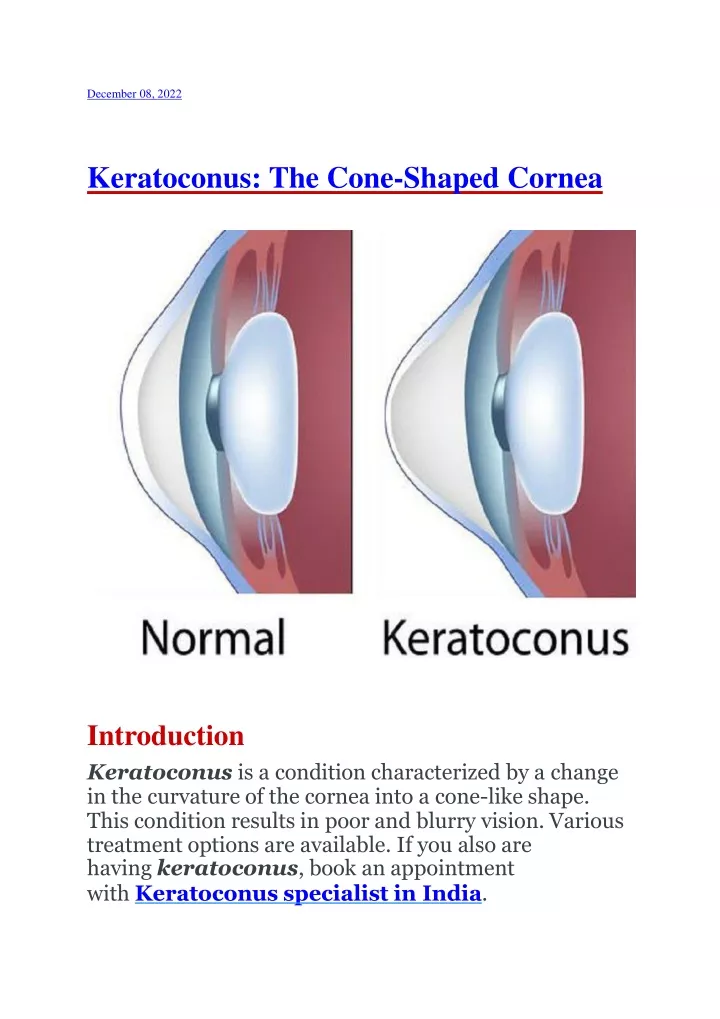keratoconus the cone shaped cornea