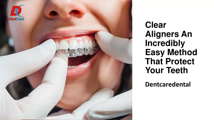 clear aligners an incredibly easy method that