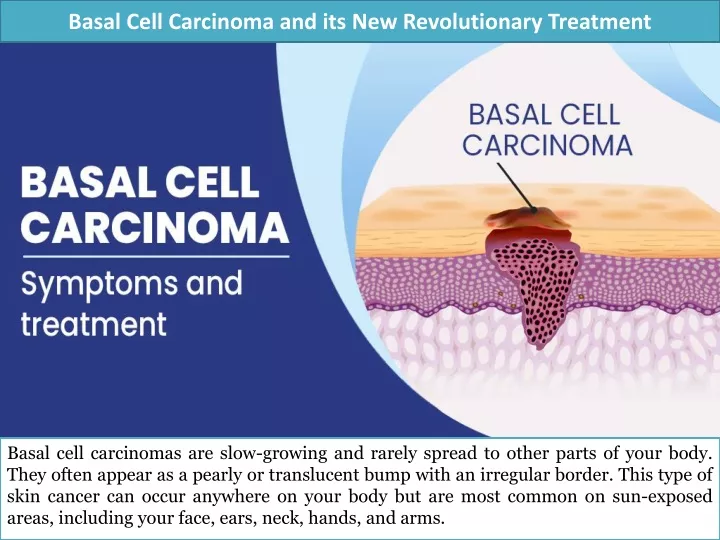 basal cell carcinoma and its new revolutionary treatment