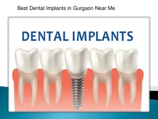 Best Dental Implants in Gurgaon