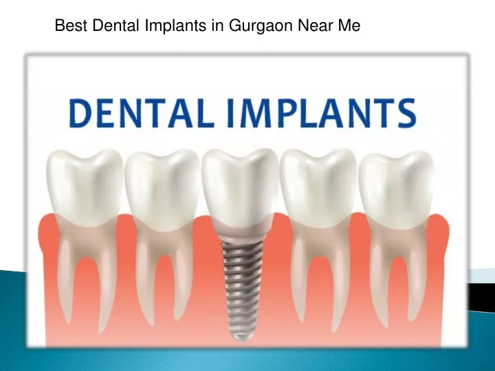 best dental implants in gurgaon near me