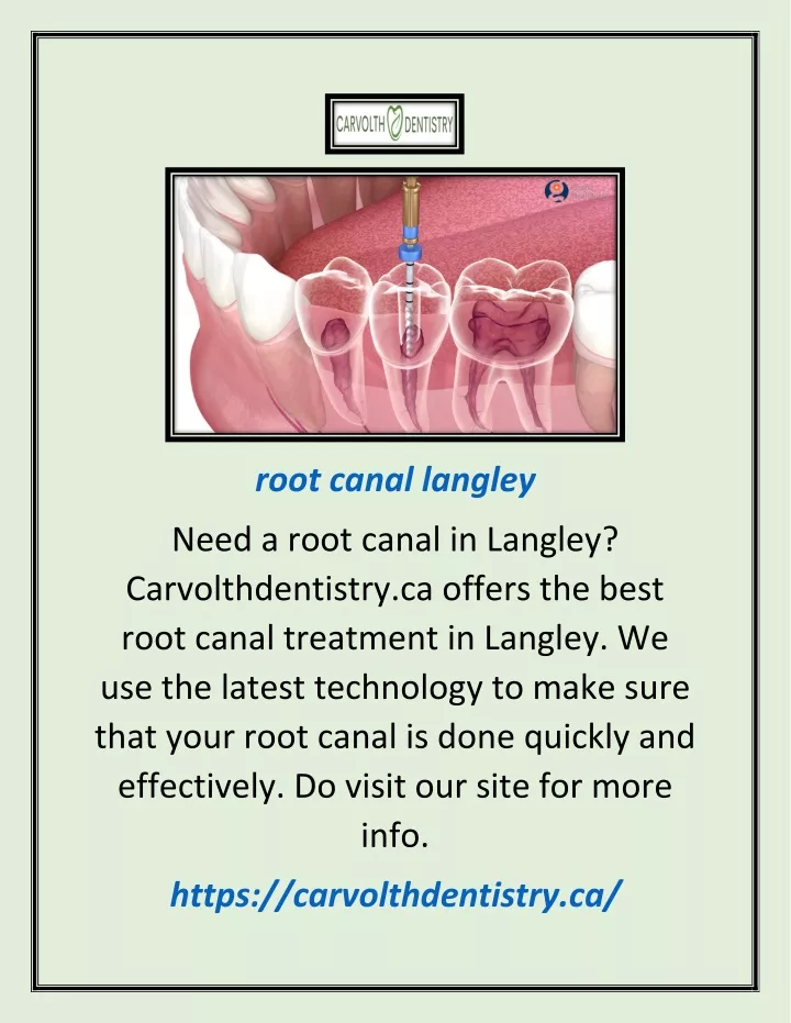 root canal langley