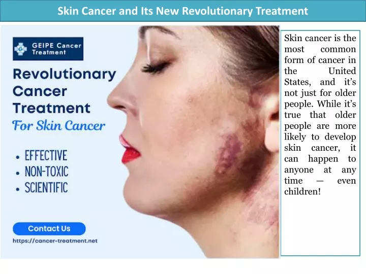 skin cancer and its new revolutionary treatment