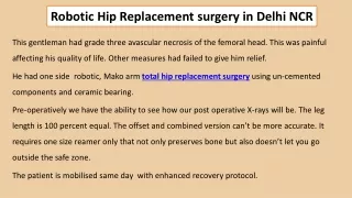 robotic hip replacement surgery in delhi ncr