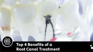 Top 4 Benefits of a Root Canal Treatment