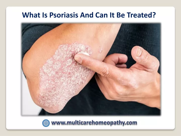 what is psoriasis and can it be treated