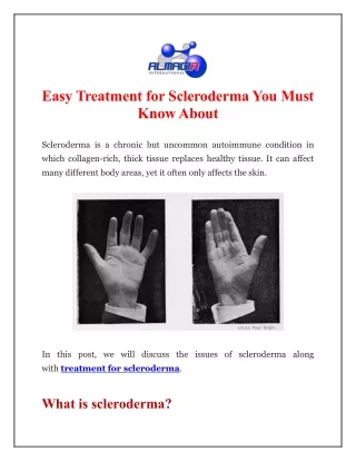 easy treatment for scleroderma you must know about