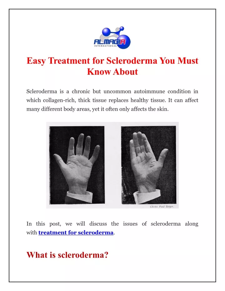 easy treatment for scleroderma you must know about