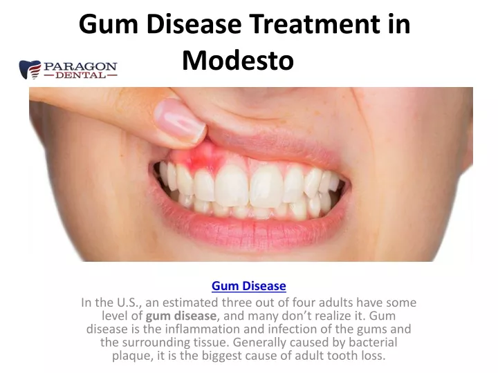 gum disease treatment in modesto