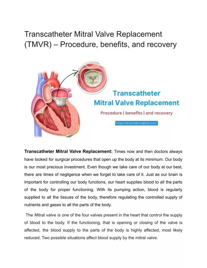 transcatheter mitral valve replacement tmvr