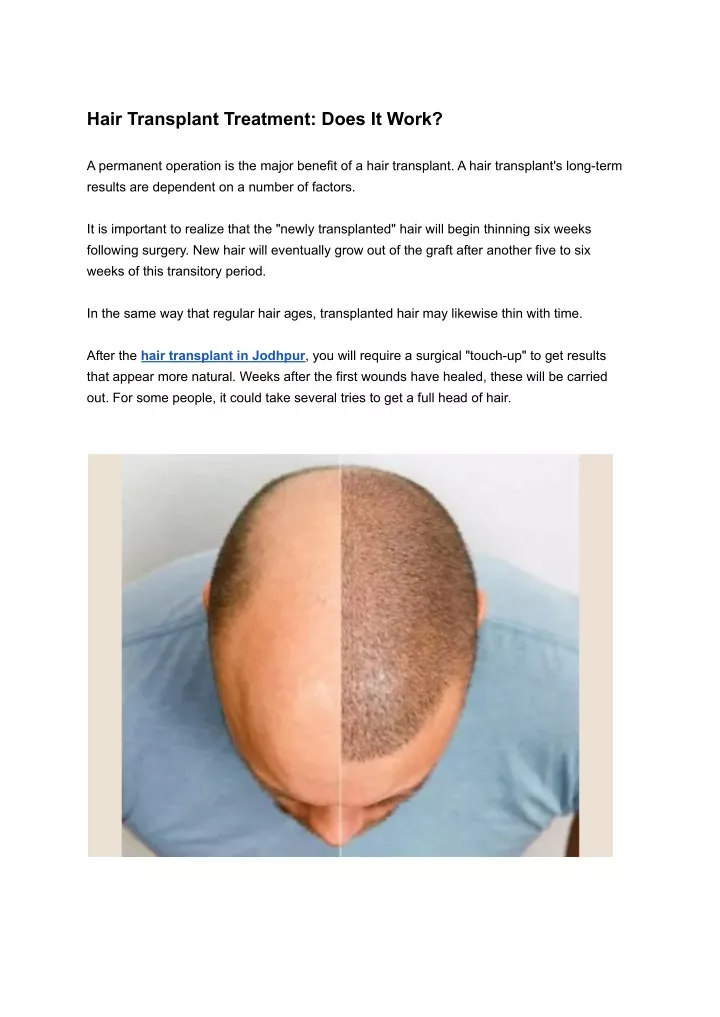 hair transplant treatment does it work