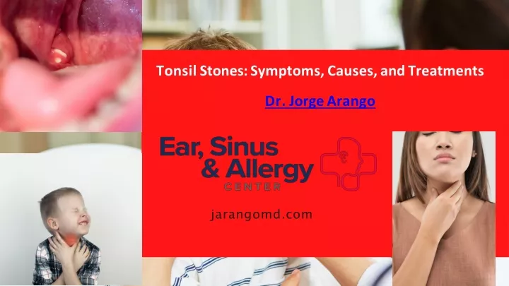 tonsil stones symptoms causes and treatments dr jorge arango