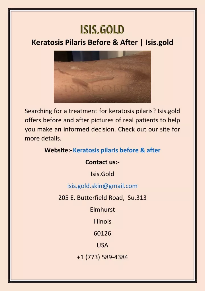 keratosis pilaris before after isis gold