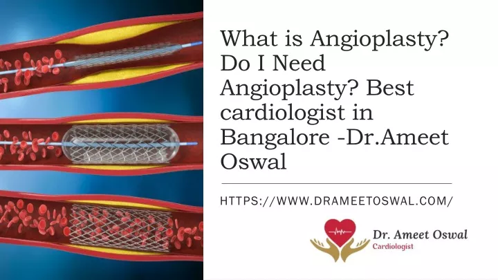 what is angioplasty do i need angioplasty best cardiologist in bangalore dr ameet oswal