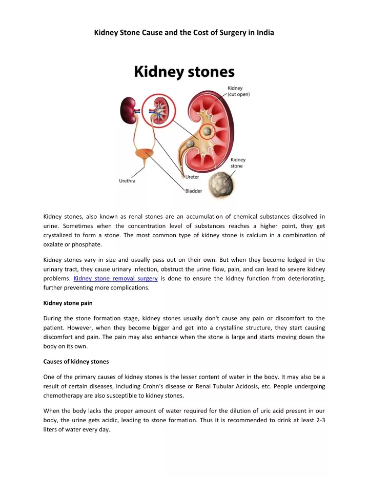 kidney stone cause and the cost of surgery