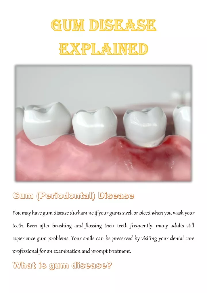 you may have gum disease durham nc if your gums