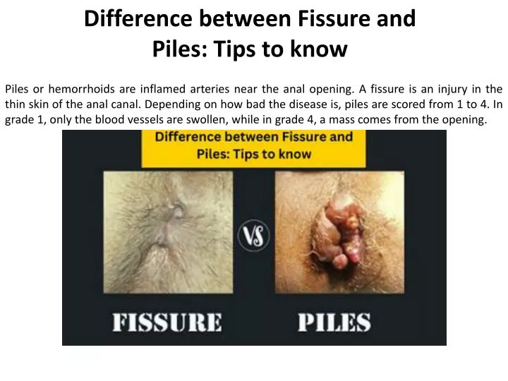 difference between fissure and piles tips to know