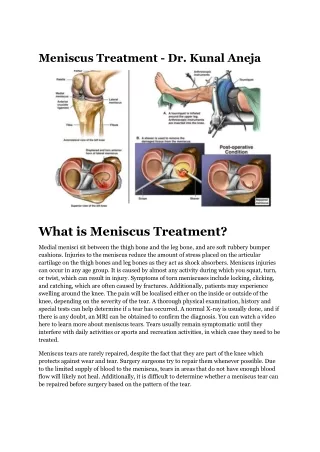 Meniscus Treatment - Dr. Kunal Aneja