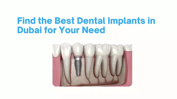 find the best dental implants in dubai for your