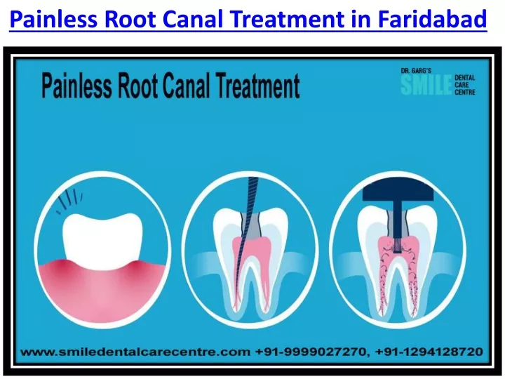 painless root canal treatment in faridabad