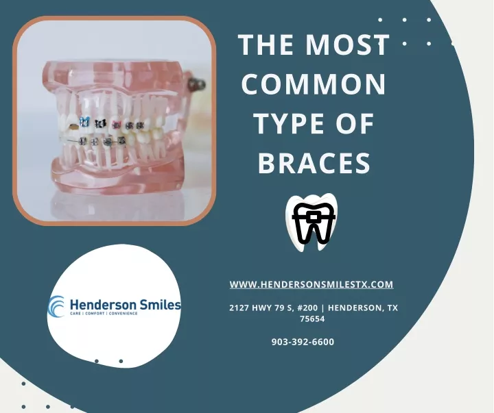 PPT - The Most Common Type Of Braces PowerPoint Presentation, Free ...