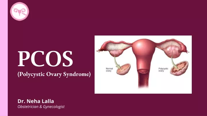 pcos polycystic ovary syndrome