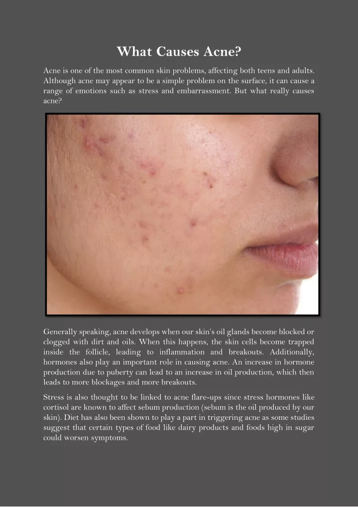 PPT - What Causes Acne PowerPoint Presentation, free download - ID:11876291