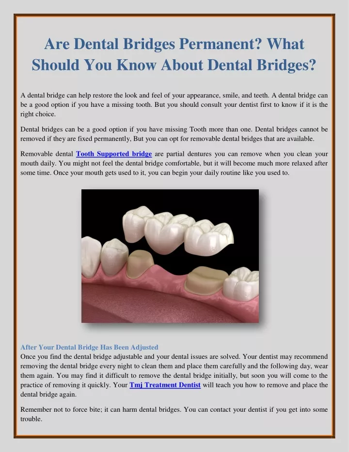 are dental bridges permanent what should you know