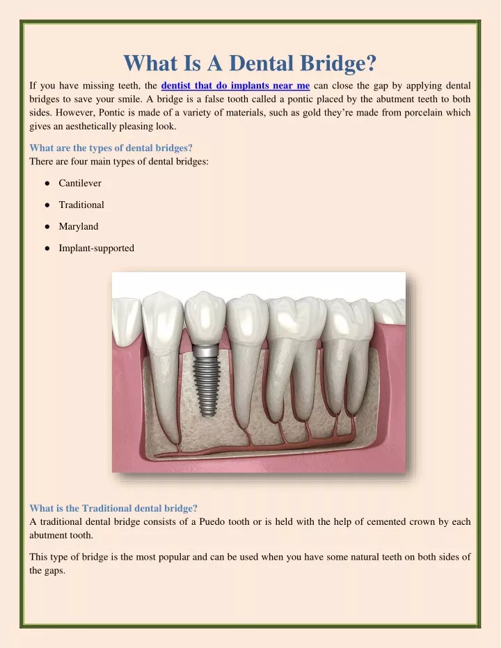 what is a dental bridge if you have missing teeth