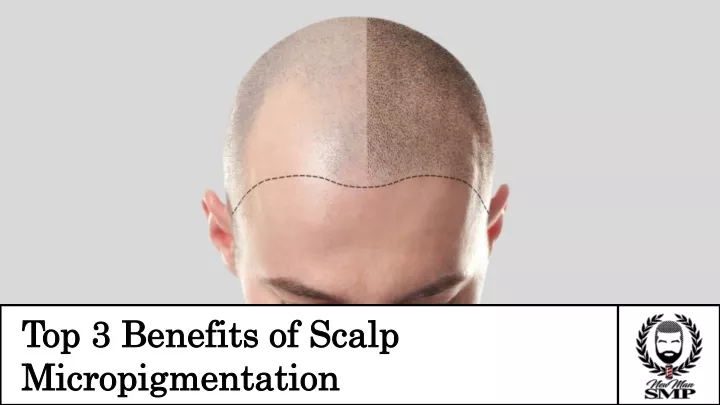 top 3 benefits of scalp micropigmentation
