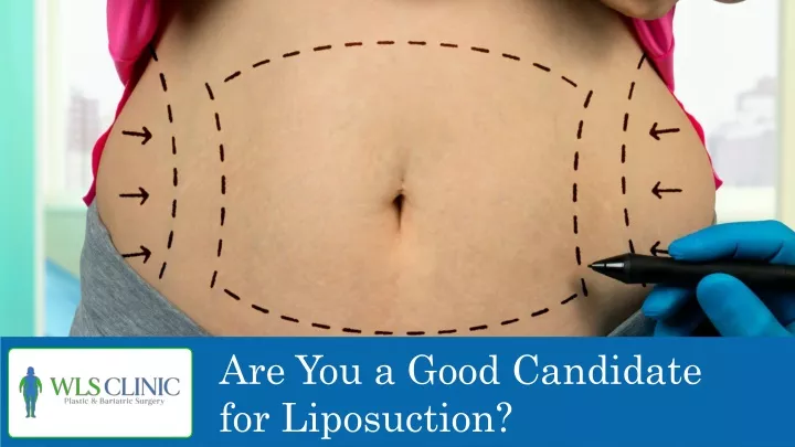 are you a good candidate for liposuction