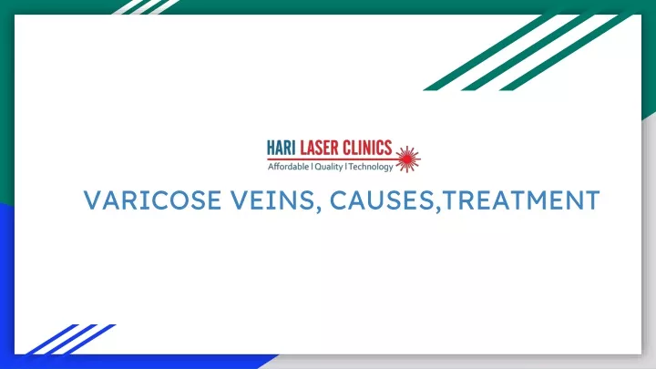 varicose veins causes treatment