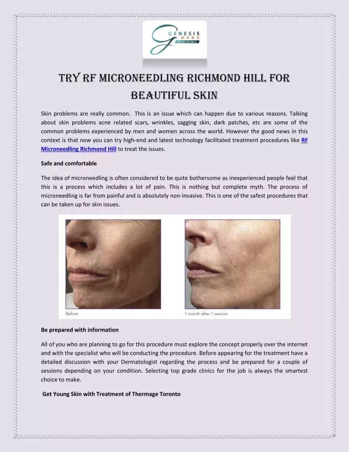 try rf microneedling richmond hill for beautiful