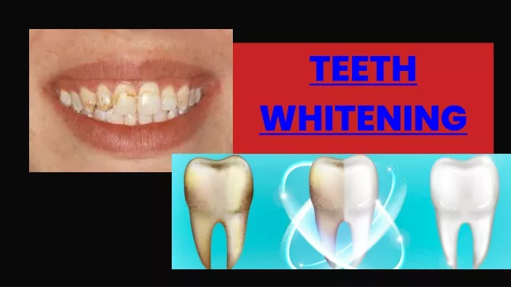 Ppt Teeth Whitening Powerpoint Presentation Free Download Id 11896253