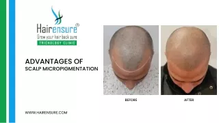 Advantages of Scalp Micropigmentation | Hair Ensure