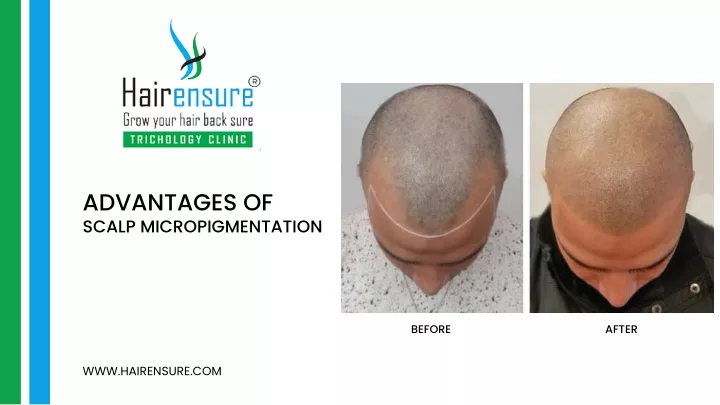 advantages of scalp micropigmentation