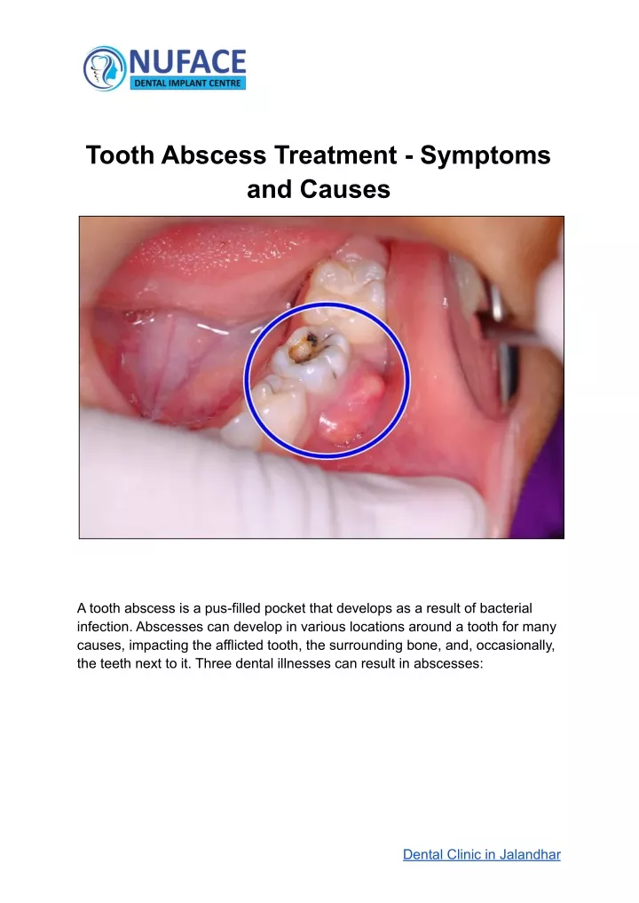 tooth abscess treatment symptoms and causes