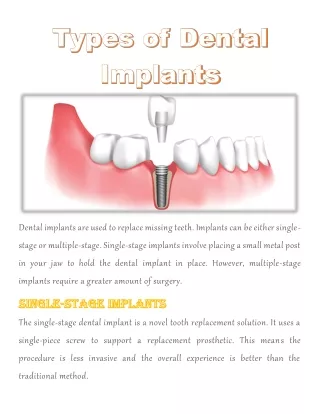 dental implants are used to replace missing teeth
